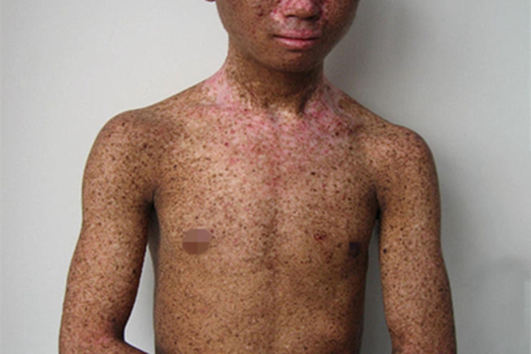 着色性干皮病全身症状图 着色性干皮病全身症状图