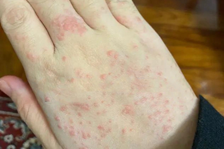 妊娠多形疹手背小红疙瘩图 妊娠多形疹手背小红疙瘩图