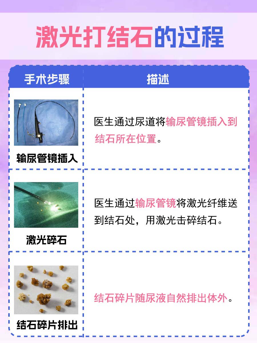 激光治疗结石,了解激光打结石的过程