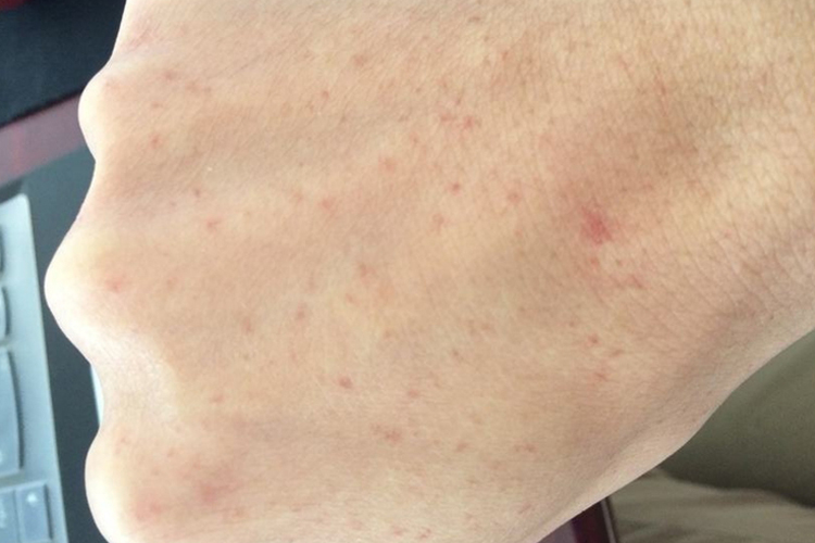 白血病手背小红点图 白血病手背小红点图