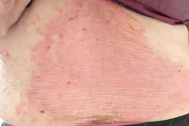 银屑病腰部症状图