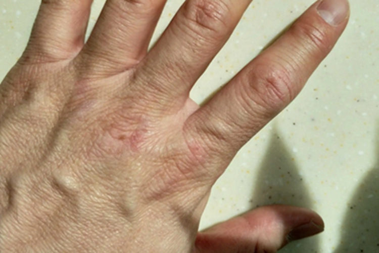 皮肌炎皮肤肿图