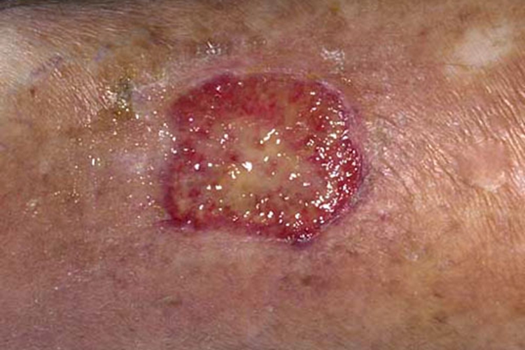 血卟啉病皮肤溃疡图