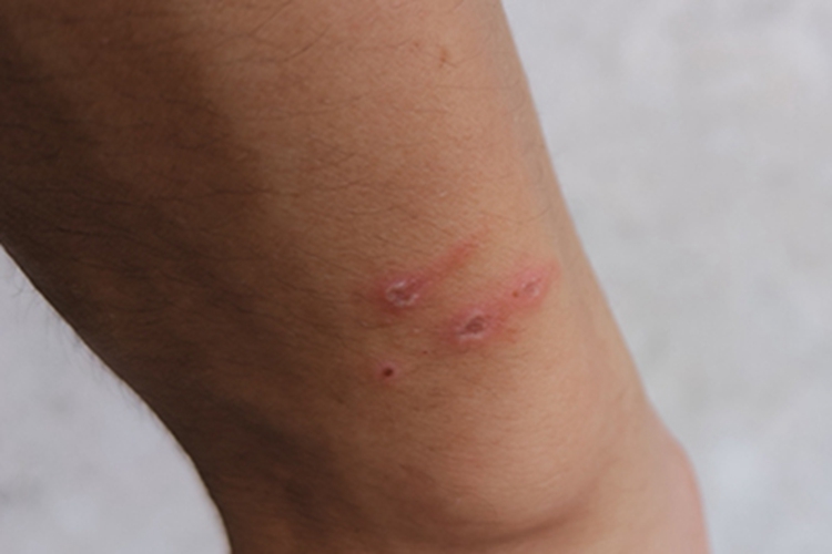 隐翅虫皮炎胳膊结痂图 隐翅虫皮炎胳膊结痂图