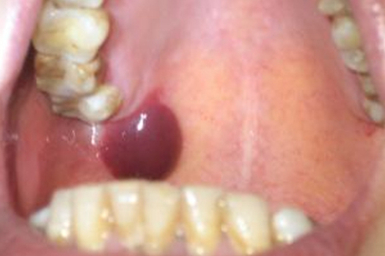 口腔长良性黏膜类天疱疮图