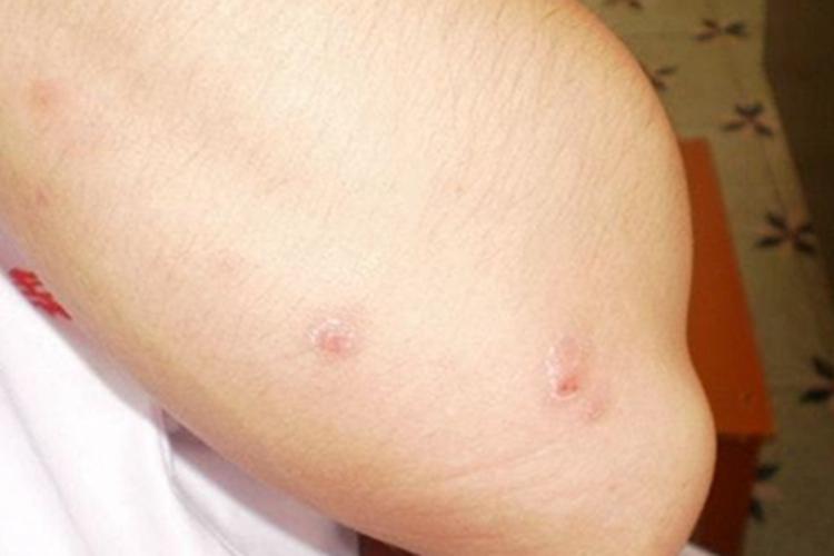 丘疹坏死性结核疹肘部结痂图 丘疹坏死性结核疹肘部结痂图