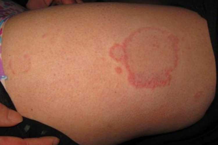 远心性环状红斑症状图