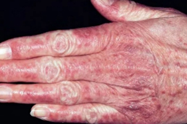 急性皮肤型红斑狼疮斑图