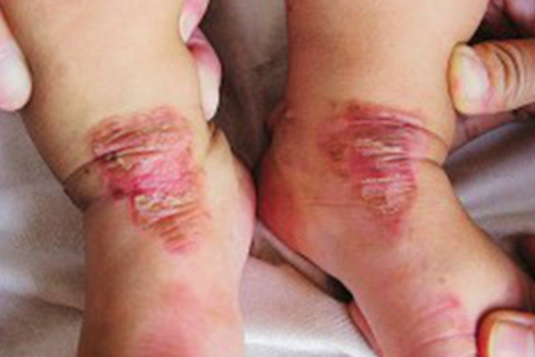 锌缺乏症红斑图 锌缺乏症红斑图