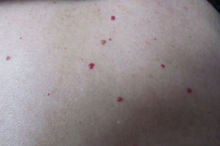 樱桃状血管瘤圆疙瘩图 樱桃状血管瘤圆疙瘩图