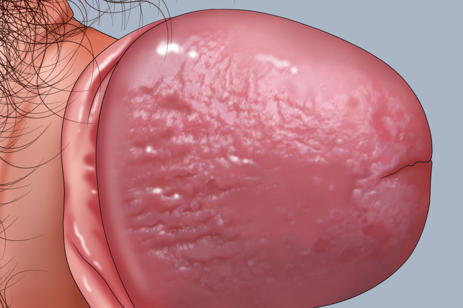 环状糜烂性包皮龟头炎龟头手绘图