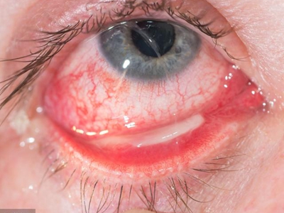 眼结膜炎怎么治疗最快图片