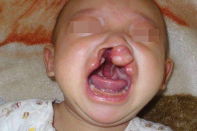 唇腭裂嘴唇畸形图 唇腭裂嘴唇畸形图
