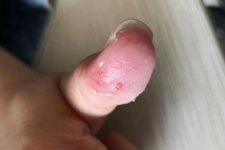 手指汗疱疹脱皮图