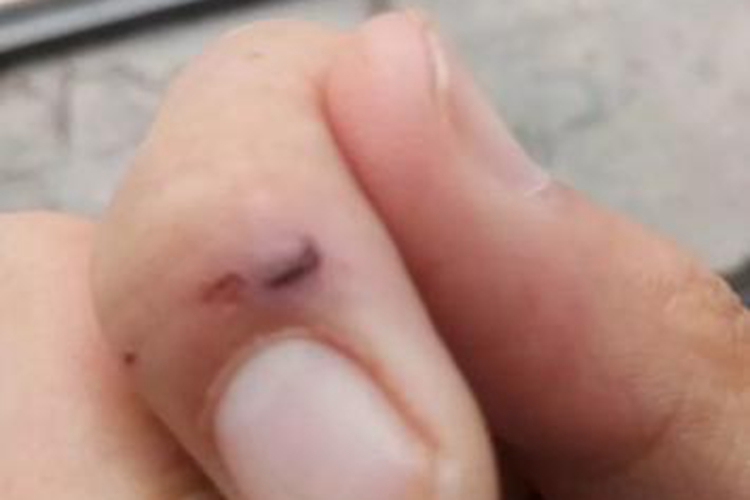 老鼠咬的伤口图