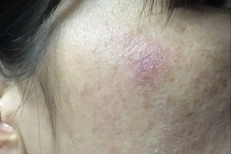 类癌综合征面部红斑图 类癌综合征面部红斑图