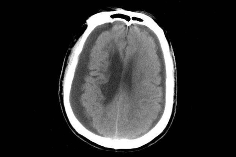慢性硬膜下血肿ct图