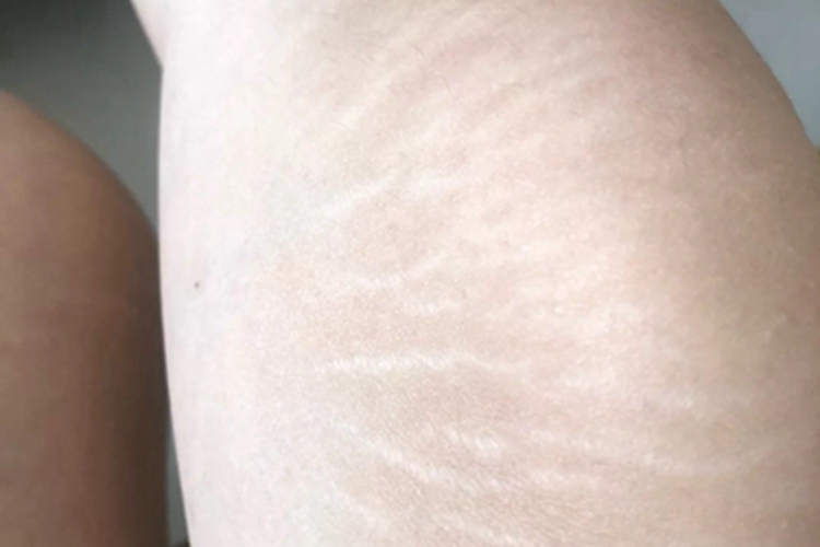 膝盖萎缩纹症状图