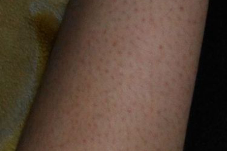 鳞状毛囊角化病胳膊症状图 鳞状毛囊角化病胳膊症状图