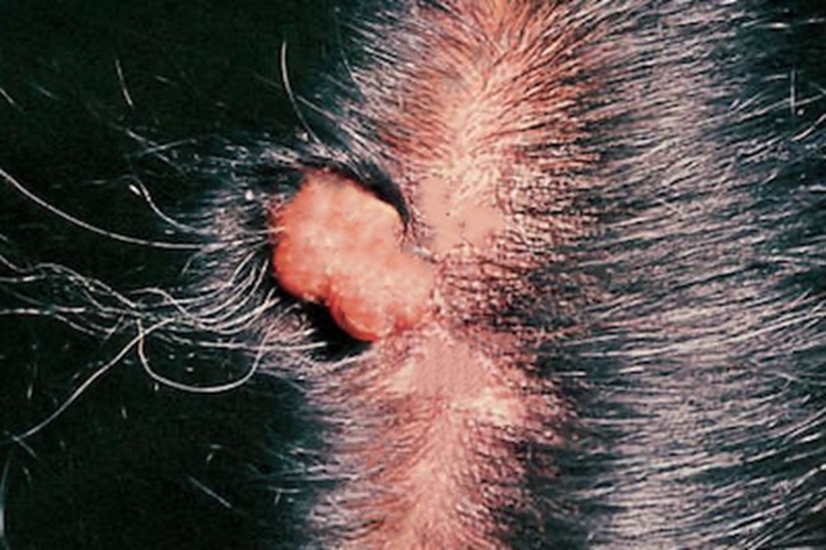 毛发囊肿头皮症状图