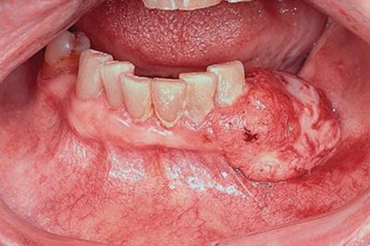 牙龈癌下牙龈长肿物图