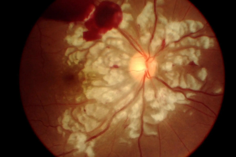 远达性视网膜病变图