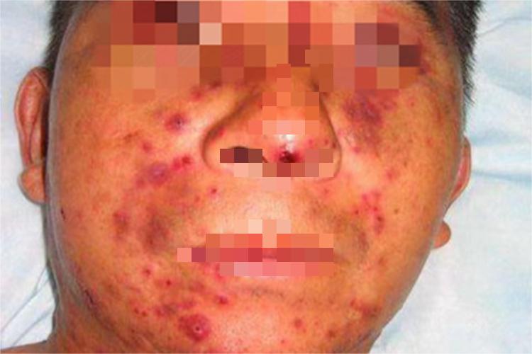 持久隆起性红斑面部丘疹图