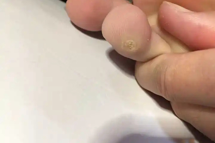 脚趾内侧长鸡眼图 脚趾内侧长鸡眼图