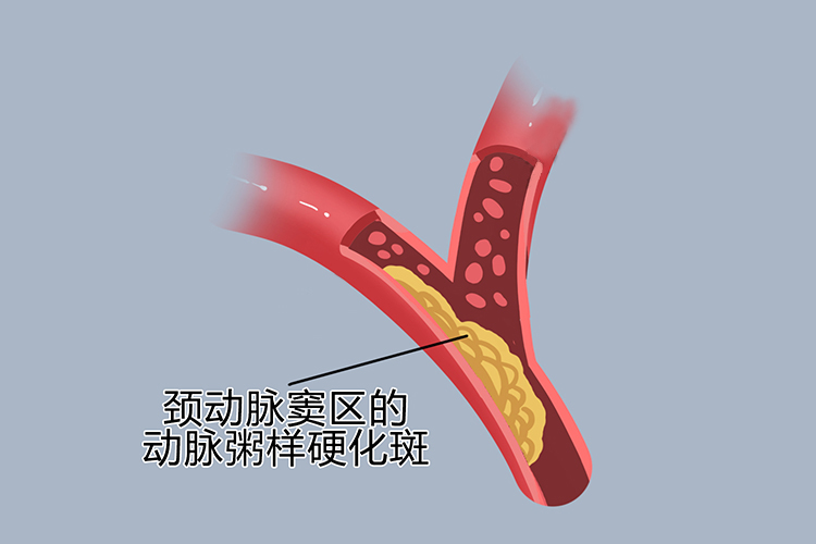 动脉粥样硬化红蓝图片