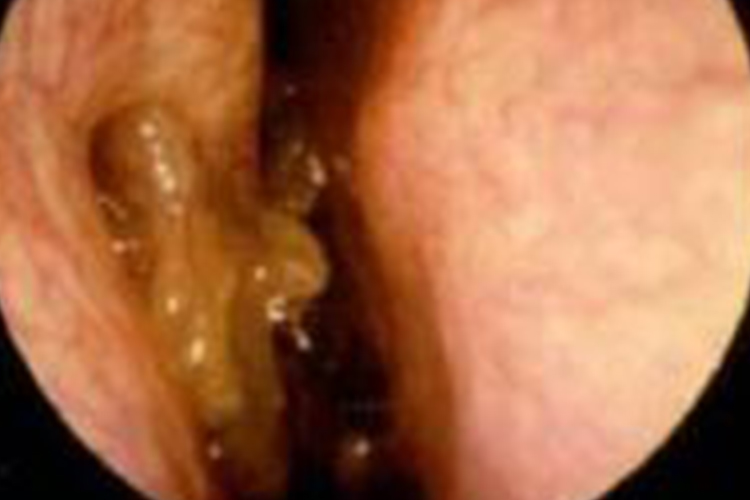 鼻部内翻性乳头状瘤图