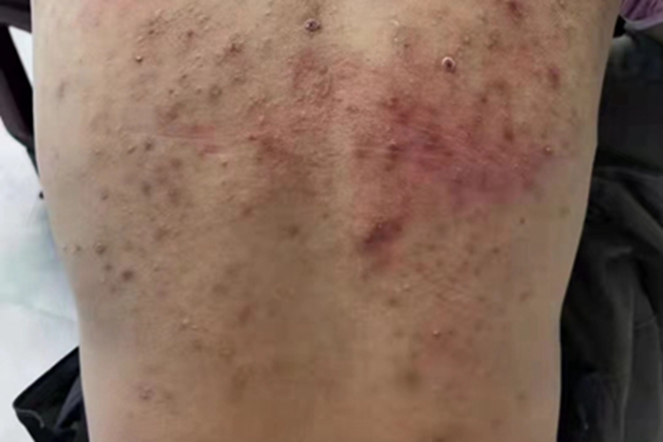 慢性湿疹疙瘩图