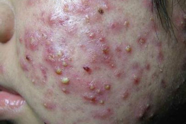 严重痤疮脓肿破溃图