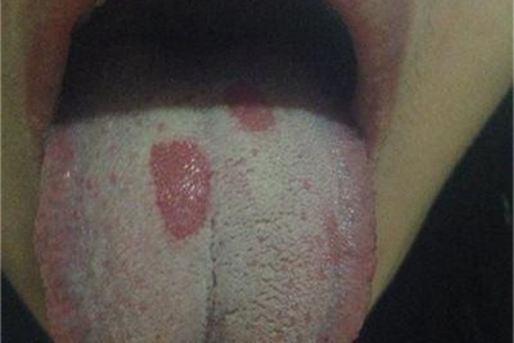 地图舌舌头上有两小块红斑图