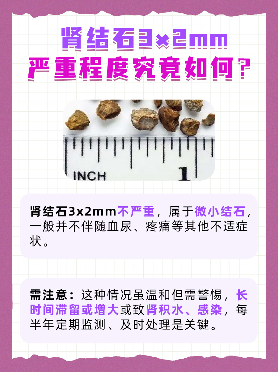 揭秘！肾结石3x2mm严重吗？