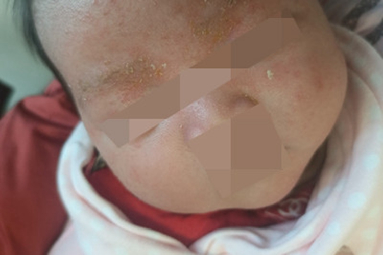 婴儿脂溢性皮炎面部症状图