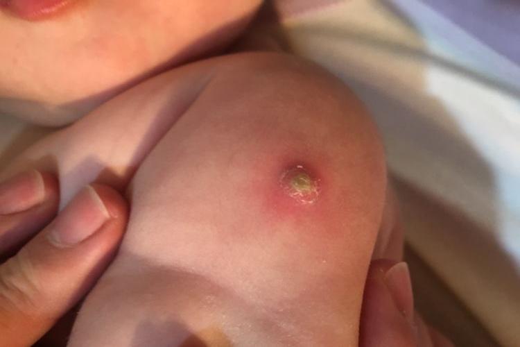 孩子胳膊上疖图