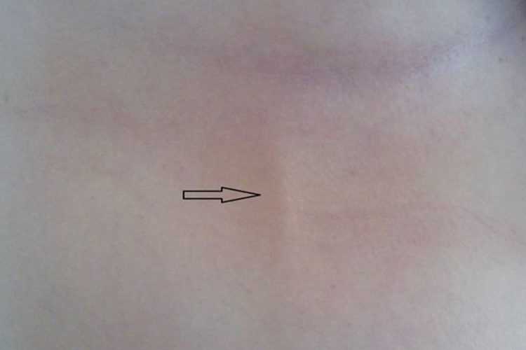 腹壁浅静脉炎图