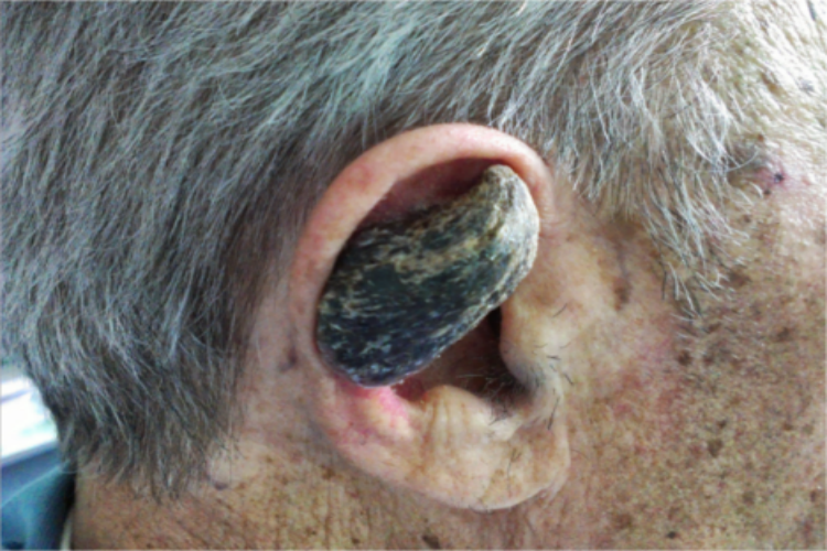 皮角耳部症状图 皮角耳部症状图