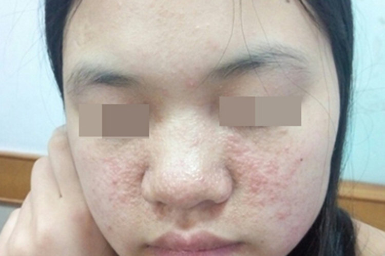 多发性毛发上皮瘤症状图