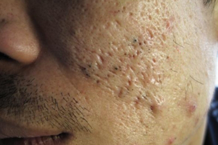 扩张孔脸上多个小黑孔图