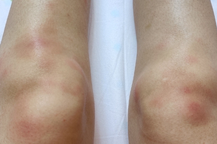 结节性红斑膝盖红斑图 结节性红斑膝盖红斑图