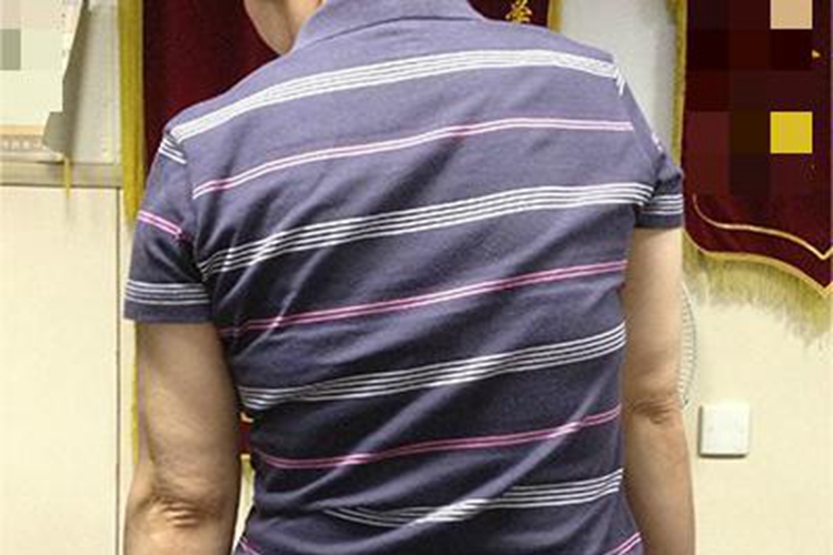 强直性脊柱炎变形图