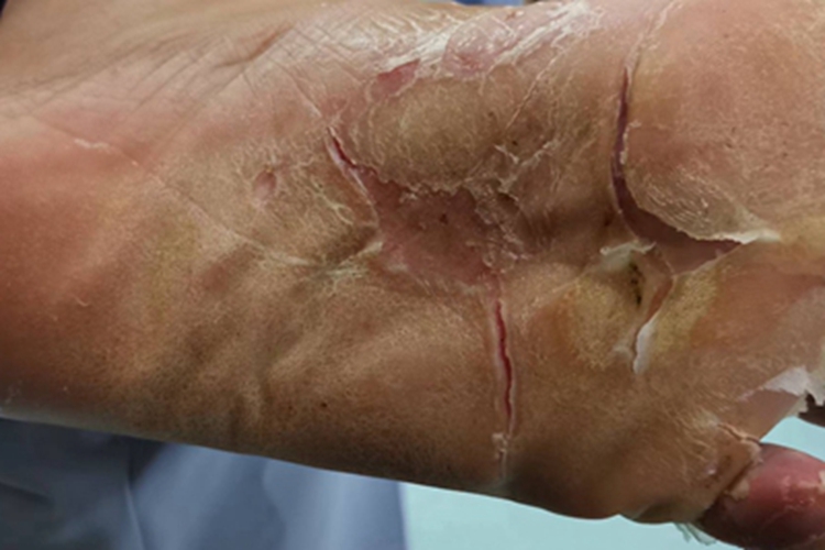 汗疱疹脚底增厚图 汗疱疹脚底增厚图