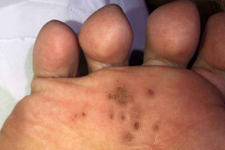 持久性豆状角化过度病脚底斑片图