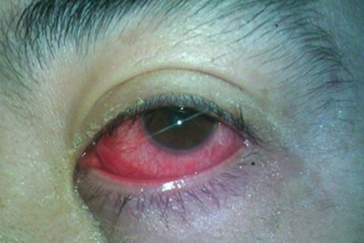 红眼病白眼球充血图 红眼病白眼球充血图