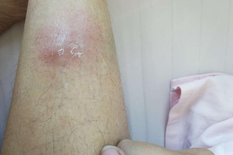 结节性红斑炎性结节图 结节性红斑炎性结节图