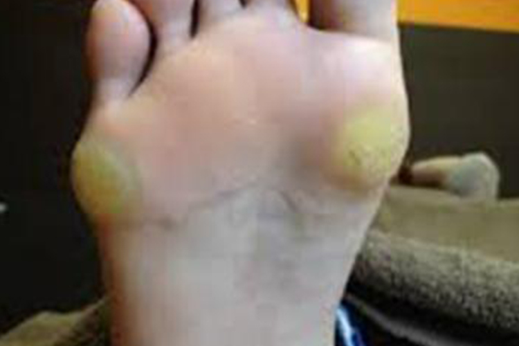 脚上胼胝图片