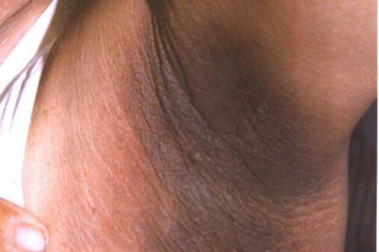 假性黑棘皮病腋窝皮肤发黑图