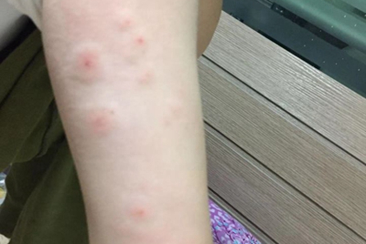 跳蚤叮咬红点图