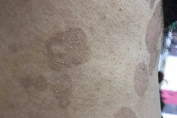 花斑糠疹背部有斑片鳞屑图